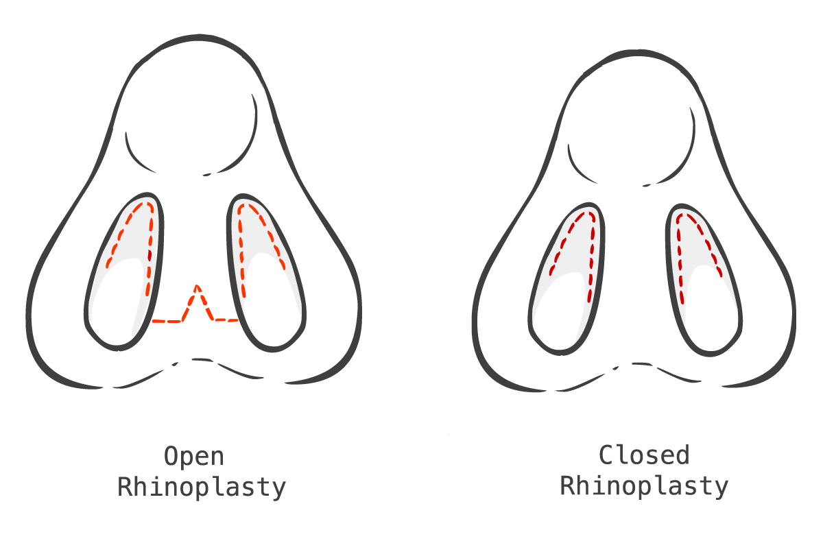 Illustration of open rhinoplasty vs. closed rhinoplasty