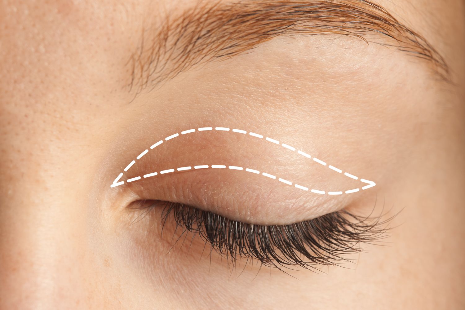 Incision marks for upper eyelid surgery