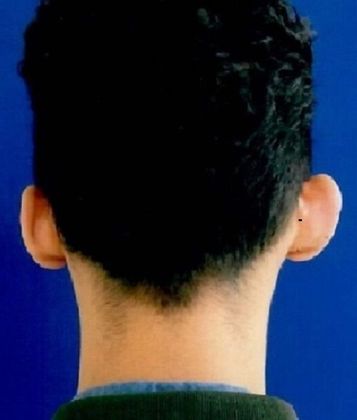 Otoplasty Case 1 - Before