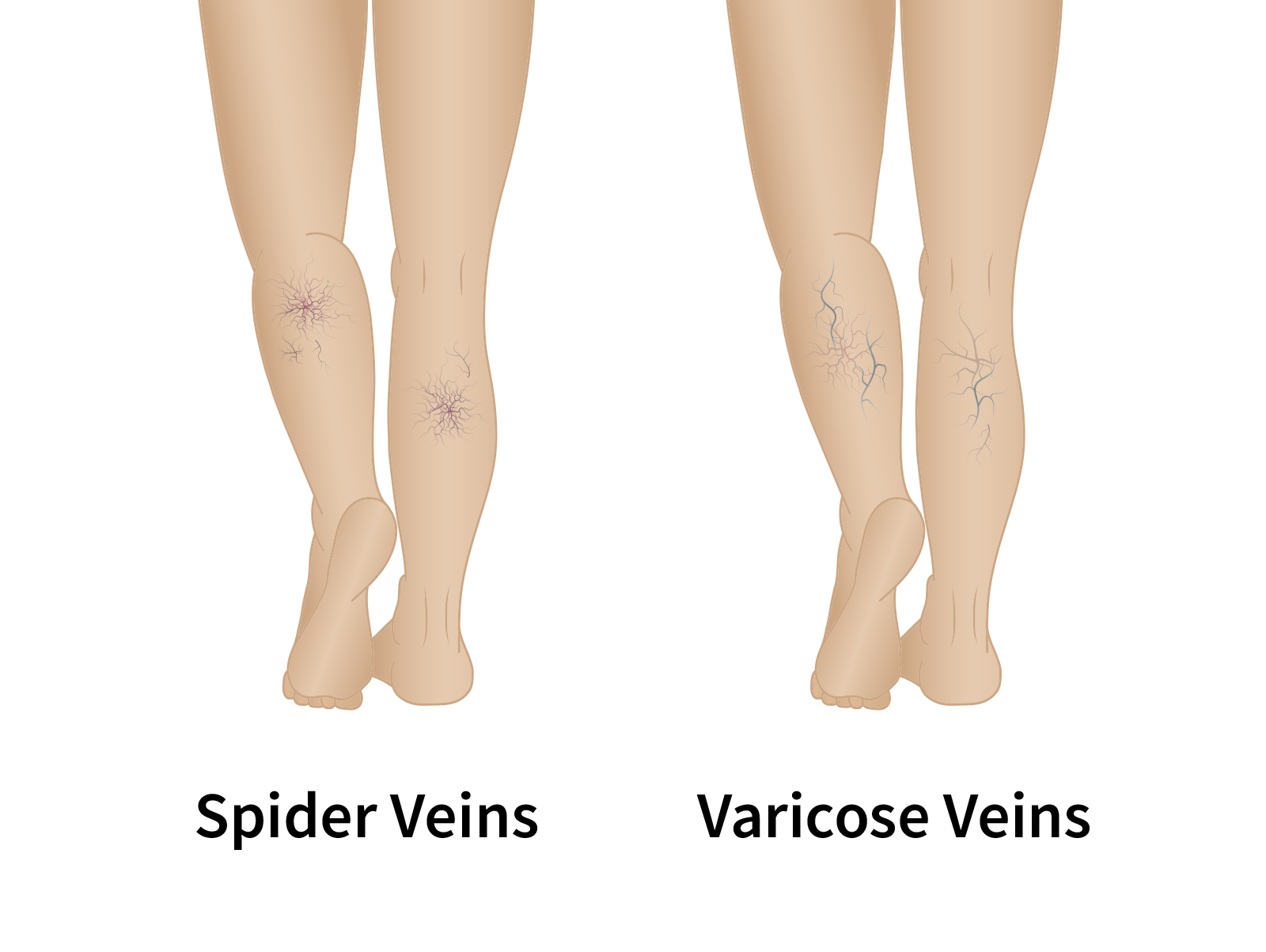 spider veins vs varicose veins
