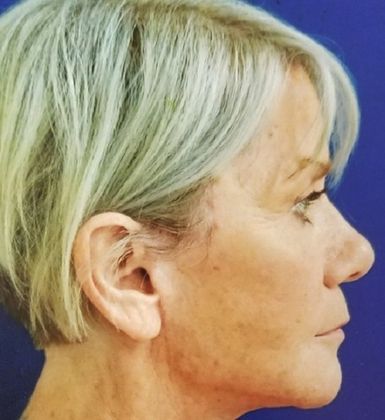 Facelift: Case 1 - After