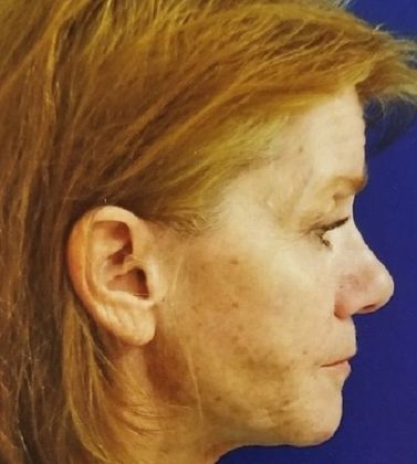 Facelift: Case 1 - Before