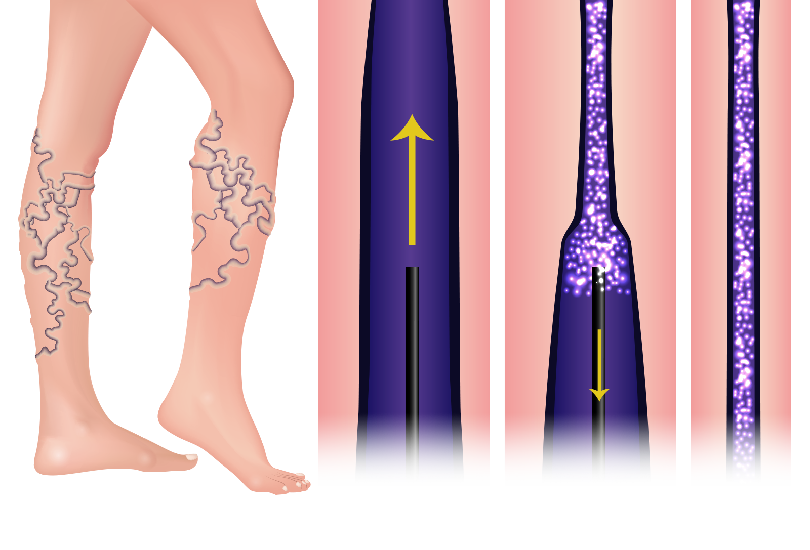 Illustration of sclerotherapy