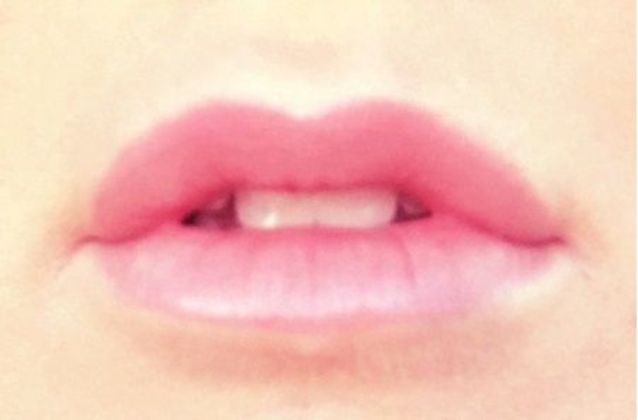 Cosmetic Injectables & Fillers Case 1 - After