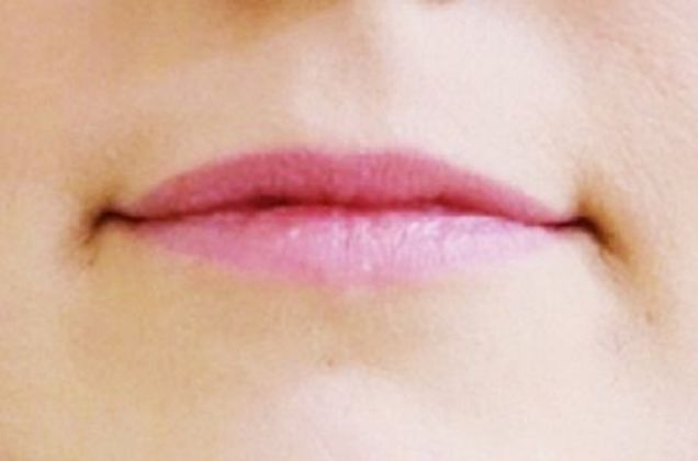 Cosmetic Injectables & Fillers Case 1 - Before
