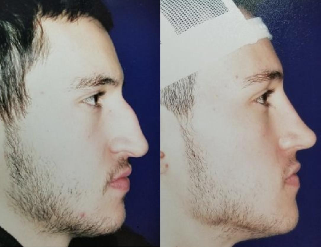 A Male Rhinoplasty Patient's Before and After Photos