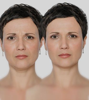 Before and after BOTOX