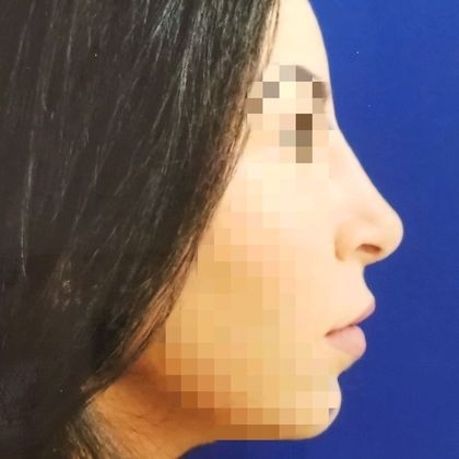 Rhinoplasty Case 3 - After