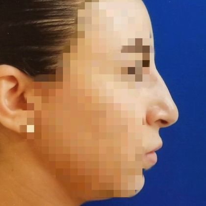 Rhinoplasty Case 3 - Before