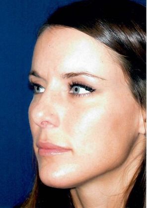 Rhinoplasty: Case 4 - After