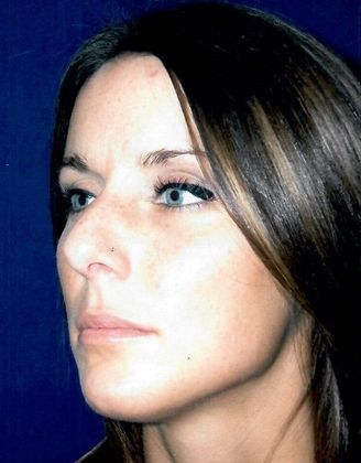 Rhinoplasty: Case 4 - Before