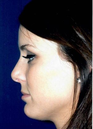 Rhinoplasty: Case 4 - After