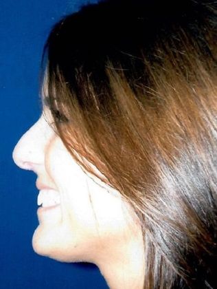 Rhinoplasty: Case 4 - Before