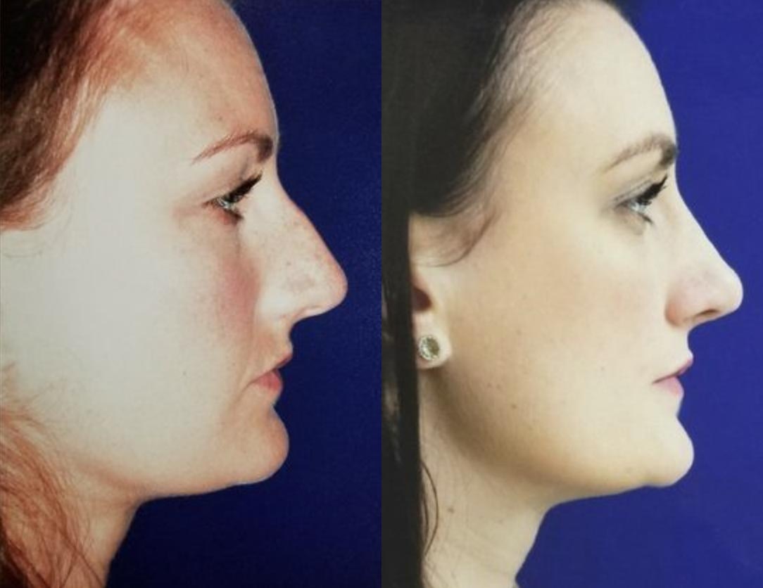 A Female Rhinoplasty Patient's Before and After Photos