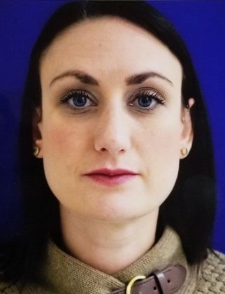 Rhinoplasty: Case 2 - After