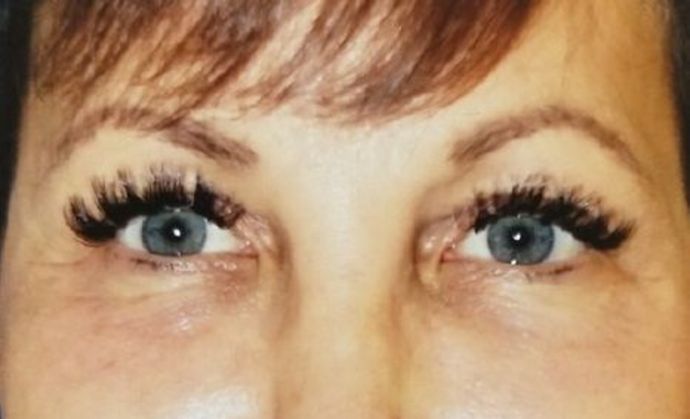 Selphyl - Platelet Rich Plasma Case 1 - After