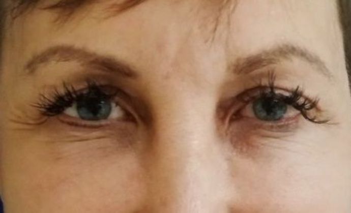Selphyl - Platelet Rich Plasma Case 1 - Before