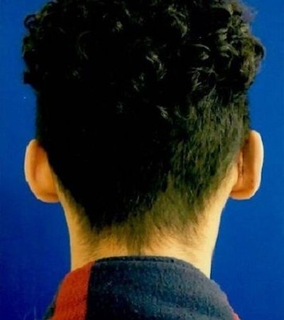 Otoplasty: Case 1 - After