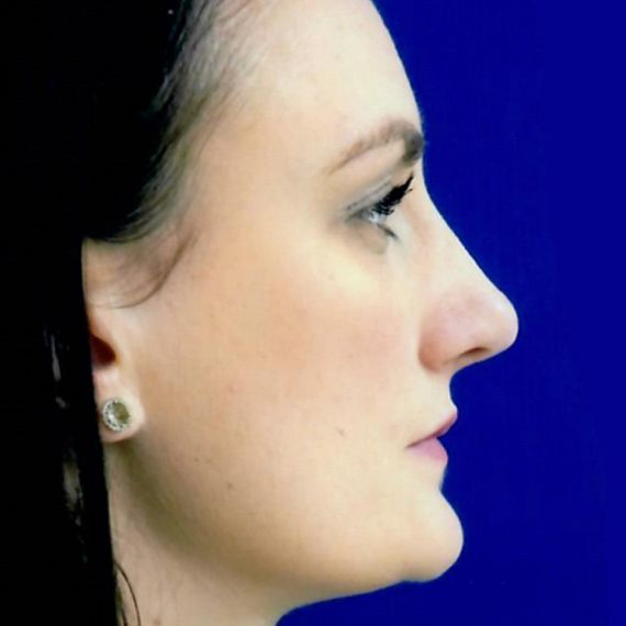 after rhinoplasty