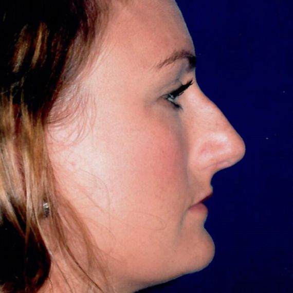 before rhinoplasty
