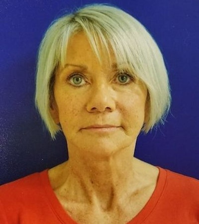 female patient after facelift