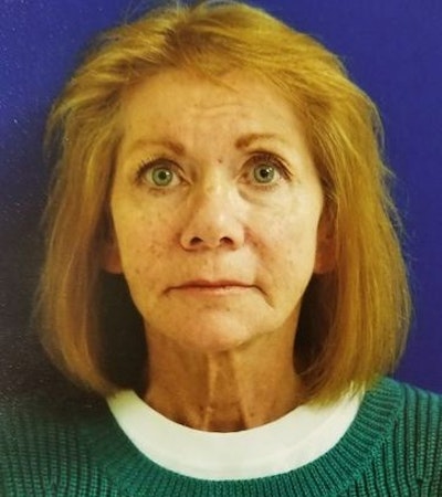female patient before facelift