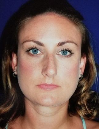 Rhinoplasty: Case 2 - Before