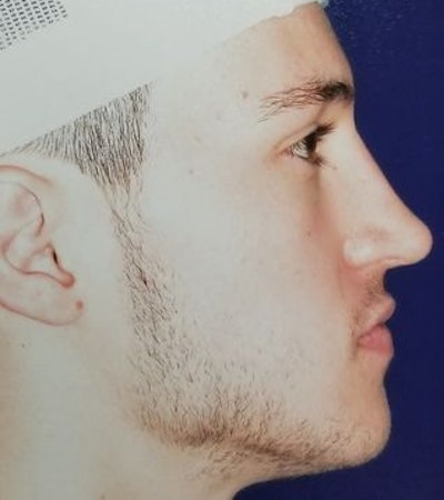 male patient after rhinoplasty