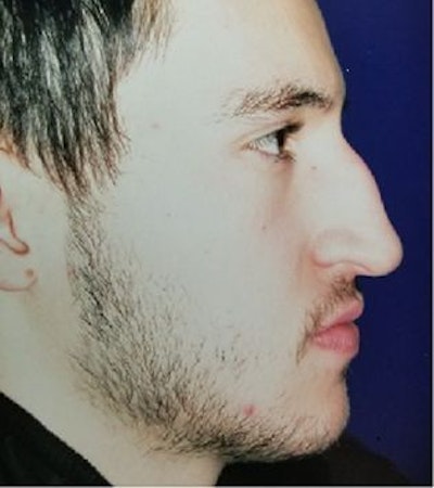 Rhinoplasty Case 1 - Before