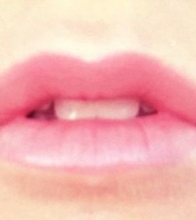 After lip injection