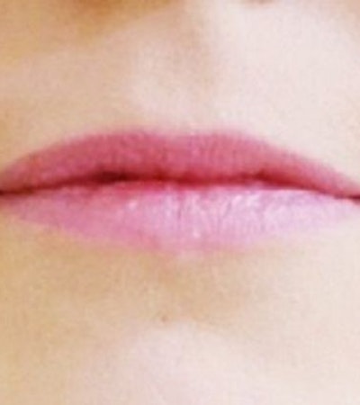 Before lip injection