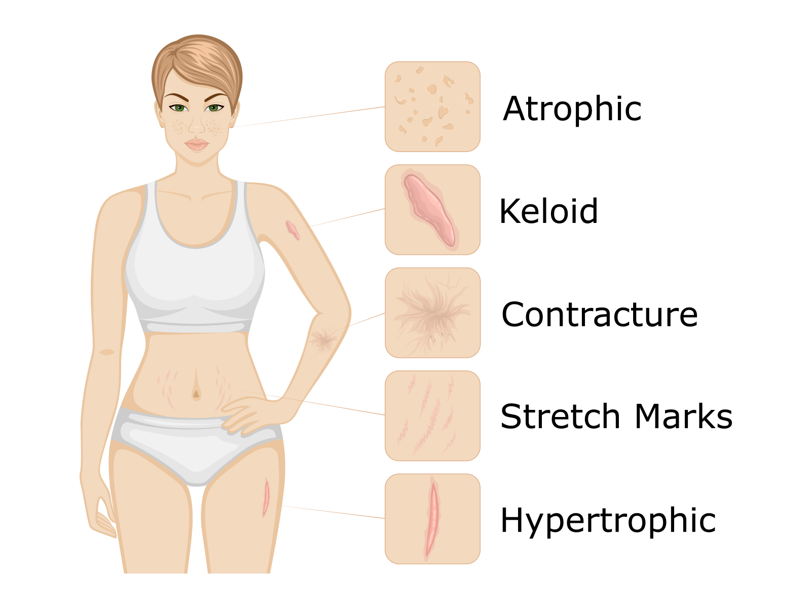 Illustration of different scar types