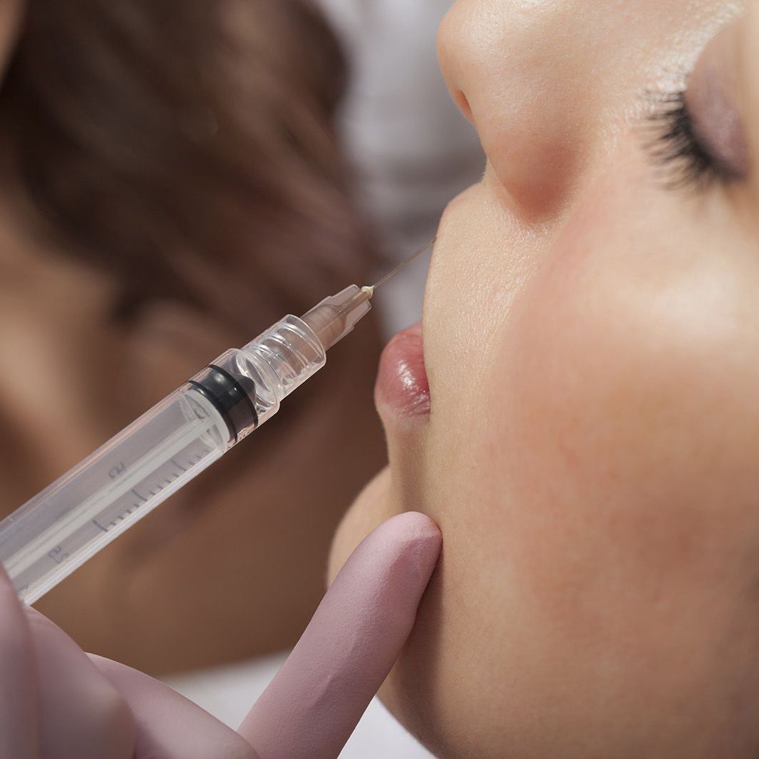 A needle with dermal filler being injected into a woman’s lip